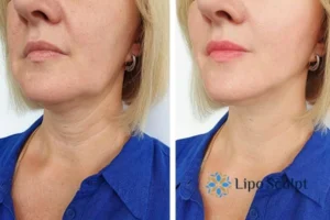 Double chin before and after Hi-Fu treatment 4 Book your double chin treatment Warwickshire today! We are here to help!
