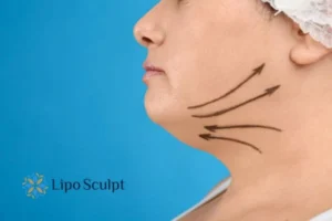 Double chin before and after Hi-Fu treatment 3 Boost your confidence with a Double chin treatment Warwickshire