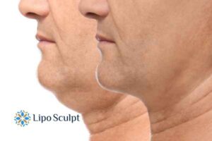 Double chin before and after Hi-Fu treatment 2 Double chin treatment Warwickshire from Lipo Sculpt - feel more confident today!