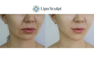 Explaining Total Skin Tightening Treatment And What It Can Do For You 2 Do you want to boost your self confidence? Give Morpheus8 Warwickshire a try today!