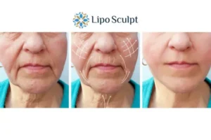 Explaining Total Skin Tightening Treatment And What It Can Do For You 3 Boost your confidence with Morpheus8 Warwickshire call our team today!