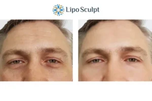 Explaining Total Skin Tightening Treatment And What It Can Do For You 6 Morpheus8 Warwickshire book in today to find out more!