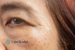 Cryopen: The Revolutionary Treatment for Age Spots Unveiled 2 Are age spots Warwickshire giving you low self esteem? Contact us today!