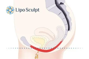 Pelvic Floor Chair Therapy 1 Pelvic Floor Chair Therapy Warwickshire to treat incontinence.