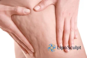 CoolSculpting for Legs: The Innovative Approach to Redefining Your Legs 5 Start your journey today book your coolsculpting treatment Warwickshire online today!