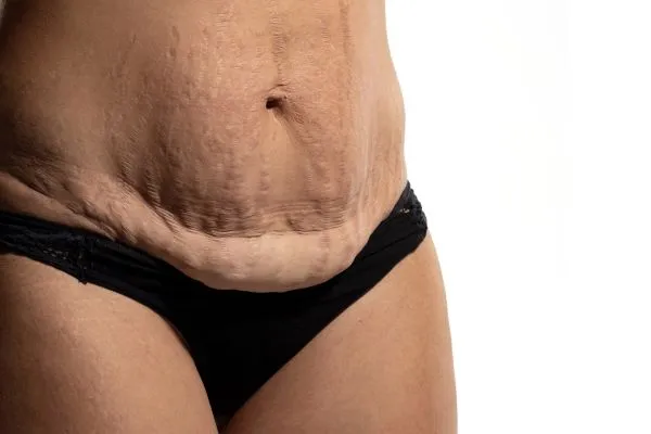 Lost the Weight but Not the Loose Skin? 1 image of womans stomach after weight loss showing loose skin Warwickshire